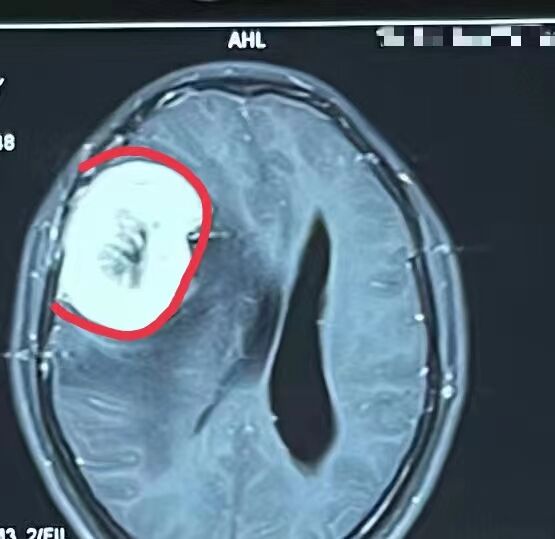 患者术前影像显示：脑膜瘤供血丰富。长沙晚报通讯员 梁辉 肖洁 供图