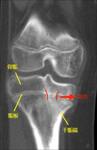 术前CT显示，患儿胫骨近端内侧骺板出现骨桥（红色箭头），导致生长停滞。