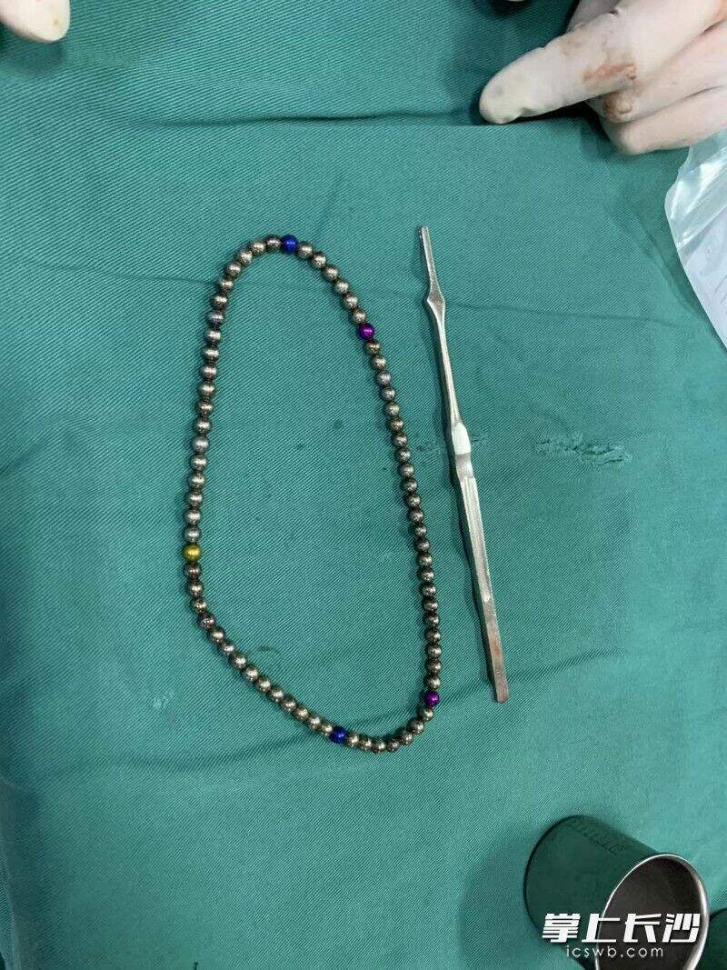 医生从小奇膀胱里取出的磁力珠。   医院供图