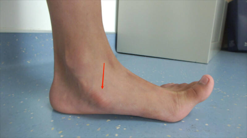 患者左足术前外观可见副舟骨（红色箭头所指）。