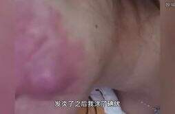 女子挤痘痘脸部感染手术缝6针 脸部红肿长包太恶心了