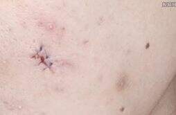 女子挤痘痘脸部感染手术缝6针 从感染到手术花了1年时间