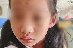 6岁女童吃瑞士卷引起头孢过敏 导致全身红肿