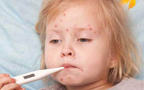 感染水痘几天能好 水痘的症状和治疗