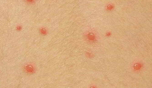 水痘传染吗 水痘的症状和图片