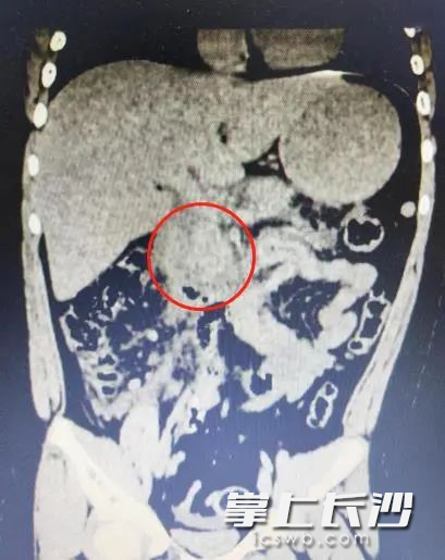 CT显示胰腺水肿渗出。  医院供图