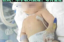 医院回应 婴儿出生后颅骨骨折