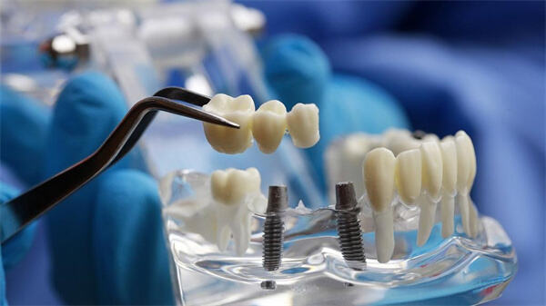 4月20日起北京实施种植牙价格大幅度降低