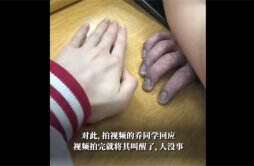 广州一学生趴睡手指被压出淤血变紫