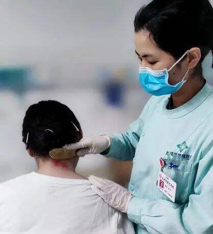 长沙市第四医院岳麓院区中医护理门诊，公司白领黄女士正在做虎符铜砭刮痧。均为长沙晚报通讯员 康芳 供图