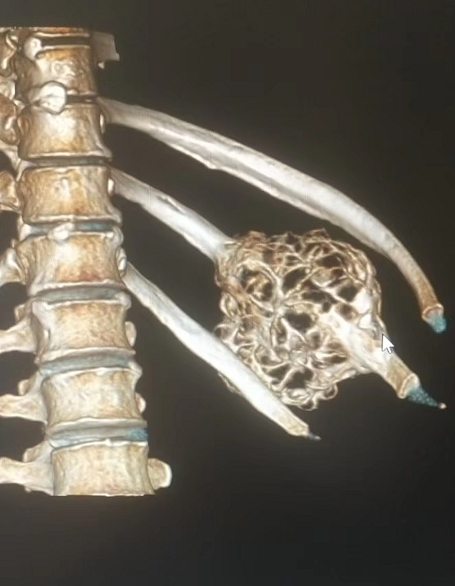 张先生的肋骨三维CT成像。