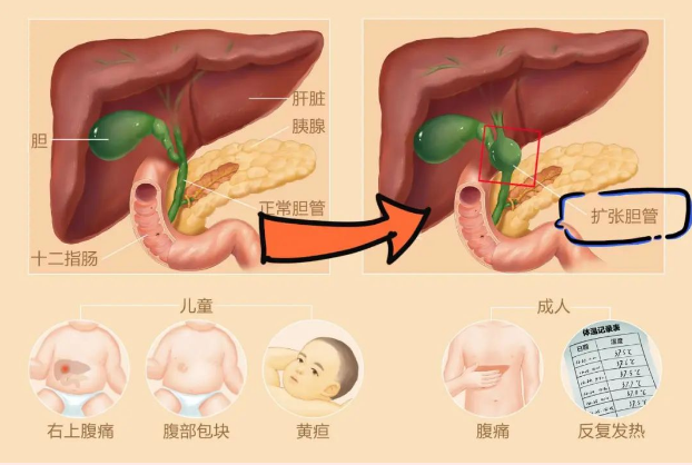 先天性胆总管囊肿又称胆管扩张症。