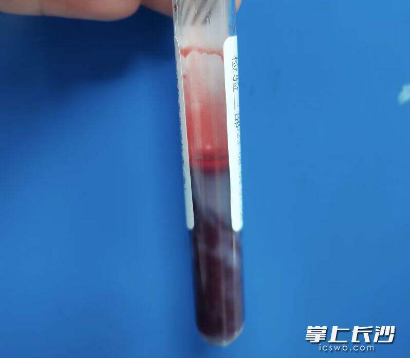 患者的血液中飘浮着白色的脂肪成分，俗称“牛奶血”。