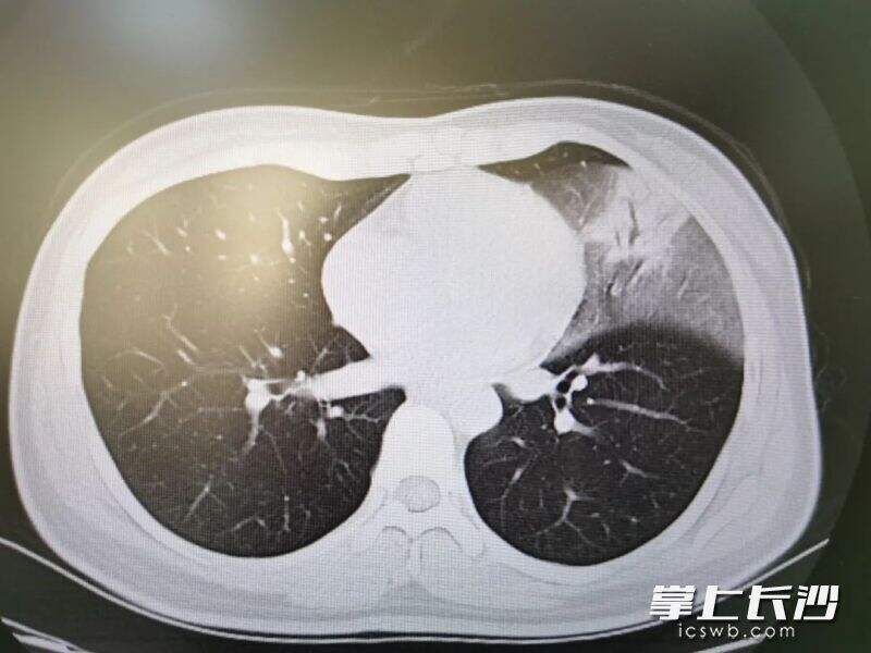 支原体肺炎肺部影像可看到雾状阴影、网格状、结节样间质性改变。