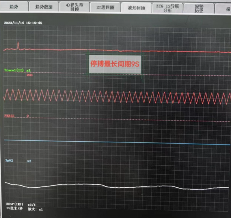 患者心衰停搏最长时为9秒，心电监护仪临床检测显示器截图。均为医院供图