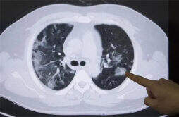 29岁姑娘确诊肺癌
