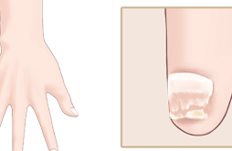 指甲有竖纹是身体的什么信号 指甲上的竖条纹代表什么问题