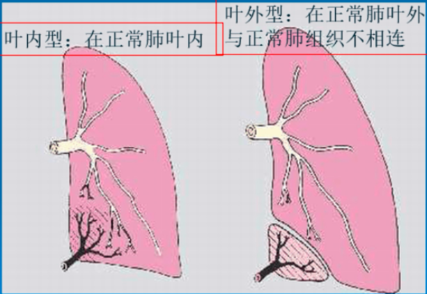 肺隔离症是一种比较罕见的先天性肺组织发育畸形，分为叶内型和叶外型。医院供图