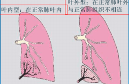 6旬老人胸口痛，竟是多长了一个不能呼吸的“肺”
