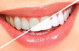 美牙贴真能使牙齿变白吗？真相是这样的