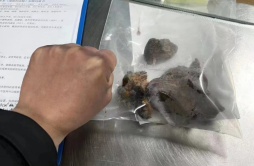 39岁男子病从口入，槟榔渣在胃内形成直径15厘米的巨大结石
